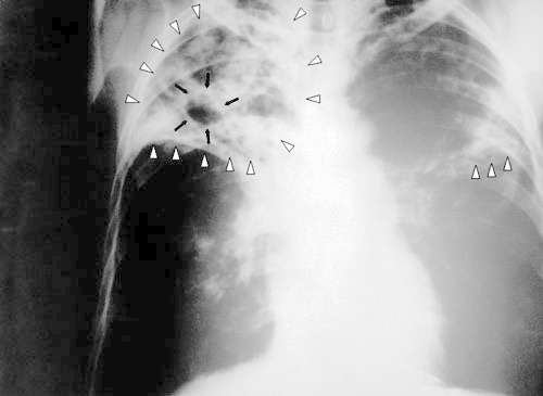 X-ray image of TB patient. Photo by http://ru.wikipedia.org X-ray image of TB patient. Photo by http://ru.wikipedia.org