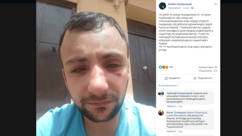 Beaten Vardan Arutyunyan. Screenshot of his Facebook post dated June 3: https://www.facebook.com/photo.php?fbid=2453172568055999&set=a.618587571514517&type=3&theater Beaten Vardan Arutyunyan. Screenshot of his Facebook post dated June 3: https://www.facebook.com/photo.php?fbid=2453172568055999&set=a.618587571514517&type=3&theater