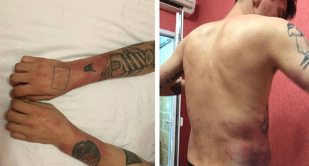 Traces of beatings on Artyom Russkikh's body. Screenshot: Mediazone, http://zona.media/article/2021/05/24/abkhasia Traces of beatings on Artyom Russkikh's body. Screenshot: Mediazone, http://zona.media/article/2021/05/24/abkhasia