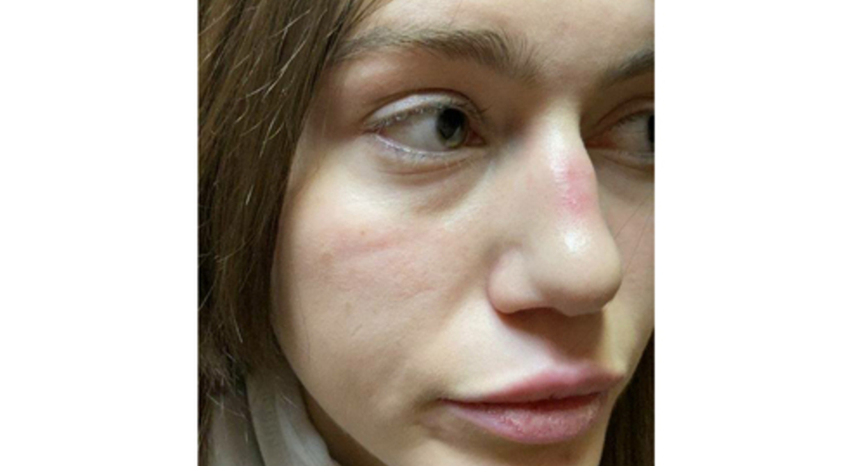 Aishat, a native of Dagestan, after her kidnapping by relatives. Screenshot of the post by the “Fortress” crisis centre https://zen.yandex.ru/media/fortress/kak-pohiscali-aishat-interviu-kreposti-62013180dd215e071cf892dd Aishat, a native of Dagestan, after her kidnapping by relatives. Screenshot of the post by the “Fortress” crisis centre https://zen.yandex.ru/media/fortress/kak-pohiscali-aishat-interviu-kreposti-62013180dd215e071cf892dd