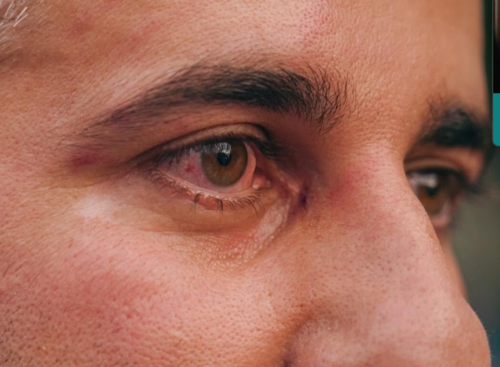 Levan Zazadze suffered an injury to his right eye. Screenshot of a photo by Mo Se from 06.06.26, https://www.facebook.com/photo?fbid=4332215717093167&set=pcb.4332215810426491 (the activities of Meta, the company that owns the social network, are banned in Russia). Levan Zazadze suffered an injury to his right eye. Screenshot of a photo by Mo Se from 06.06.26, https://www.facebook.com/photo?fbid=4332215717093167&set=pcb.4332215810426491 (the activities of the company Meta, which owns the social network, are prohibited in Russia).